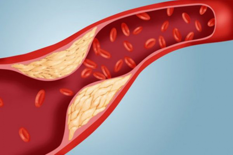 Phác đồ điều trị rối loạn lipid máu như thế nào mới hiệu quả?
