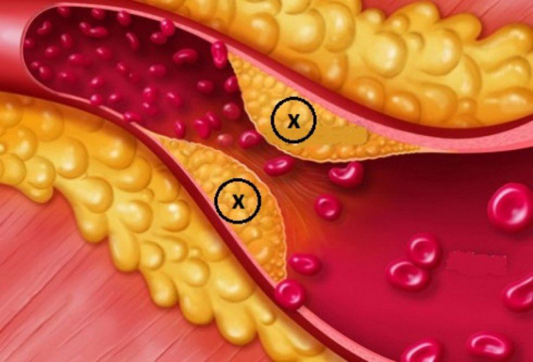 Rối loạn lipid máu là gì? Cách nhận biết và phòng ngừa như thế nào?
