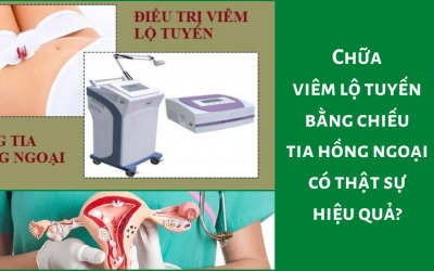 Chiếu tia hồng ngoại chữa viêm lộ tuyến cổ tử cung