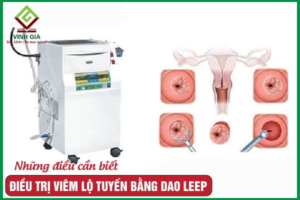 Điều trị viêm lộ tuyến bằng dao LEEP là gì? Ưu và nhược điểm?