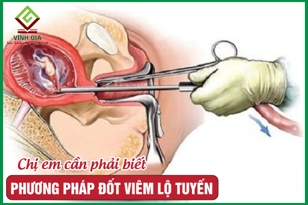 Đốt viêm lộ tuyến cổ tử cung: Có nên hay không?