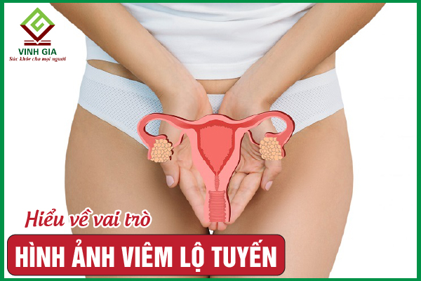 Hình ảnh viêm lộ tuyến cổ tử cung theo từng mức độ