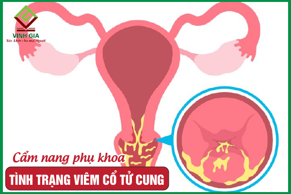 Viêm cổ tử cung: Nguyên nhân, triệu chứng và cách điều trị