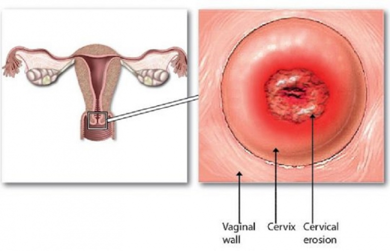 Viêm lộ tuyến cổ tử cung dạng sùi: Nguyên nhân và cách điều trị hiệu quả