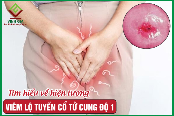 Hiểu để điều trị hiệu quả viêm lộ tuyến cổ tử cung độ 1
