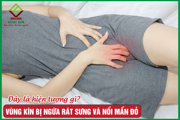 Cách trị hiện tượng vùng kín bị ngứa rát sưng và nổi mẩn đỏ