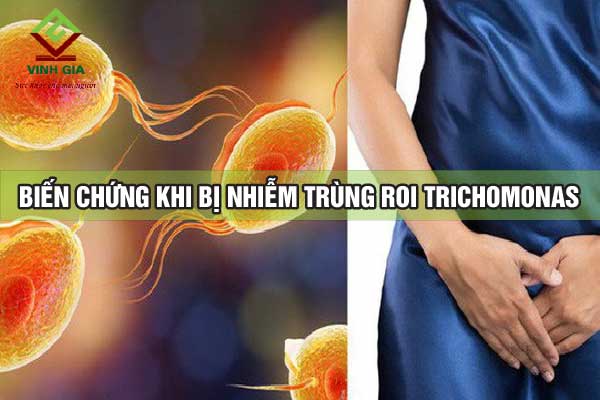 Biến chứng nguy hiểm khi bị viêm âm đạo do trùng roi Trichomonas