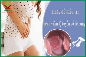 “Chuẩn” phác đồ điều trị viêm lộ tuyến cổ tử cung hiệu quả