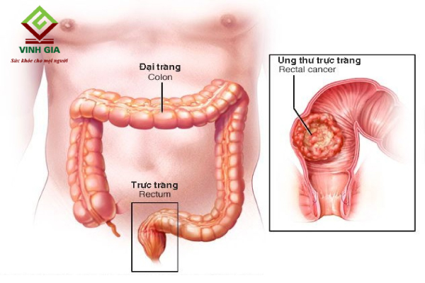 Đau bụng quặn kèm tiêu chảy là dấu hiệu của bệnh ung thư đại trực tràng