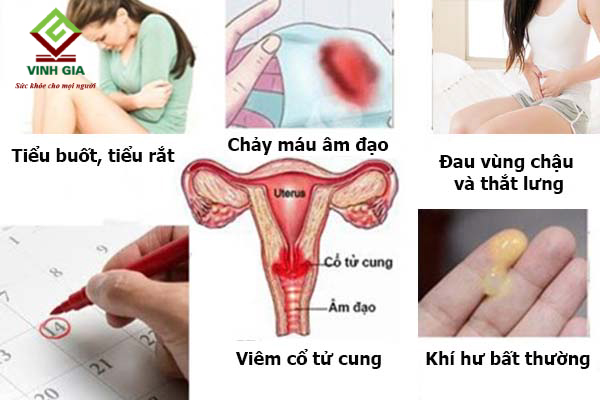 Dấu hiệu bệnh viêm cổ tử cung sau sinh