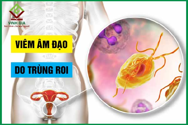 Biến chứng nguy hiểm của viêm âm đạo do trùng roi trichomonas