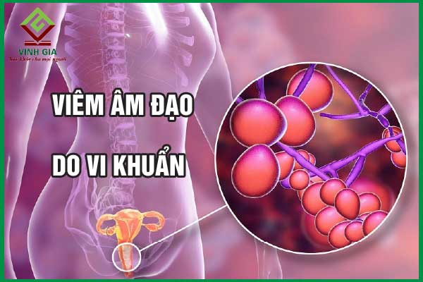 Viêm âm đạo do vi khuẩn và cách điều trị