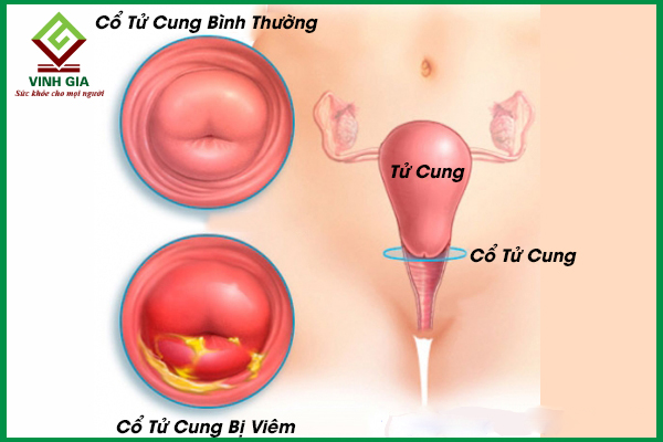 Viêm cổ tử cung có gây chậm kinh ở chị em không?