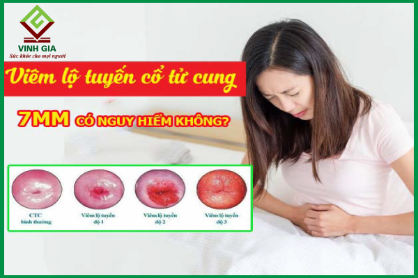 Viêm lộ tuyến cổ tử cung 7mm là cấp độ mấy?