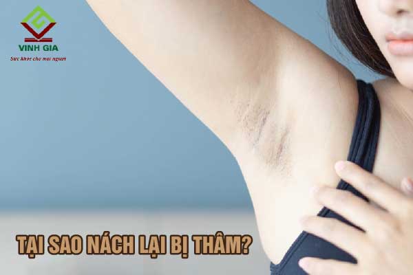Lý do khiến nách bị thâm Lý do khiến nách bị thâm