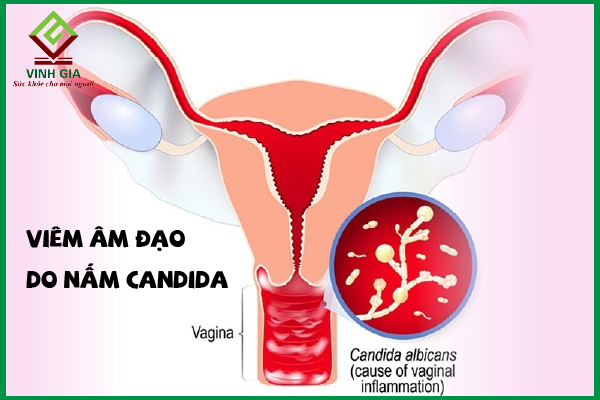 Viêm âm đạo do nấm Candida – Những điều cần biết