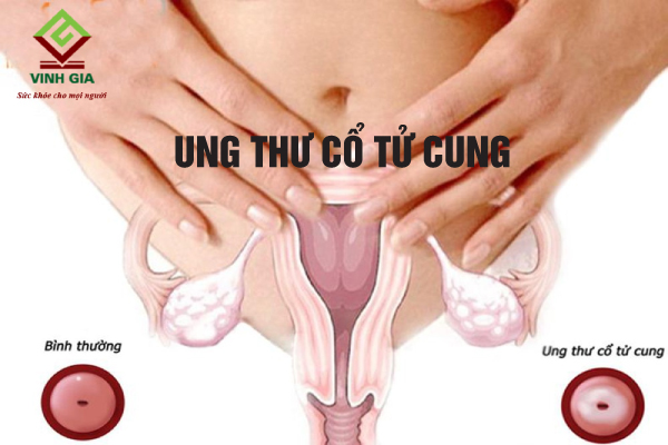 Bệnh viêm lộ tuyến không được trị dứt điểm sẽ gây nguy cơ mắc ung thư cổ tử cung Bệnh viêm lộ tuyến không được trị dứt điểm sẽ gây nguy cơ mắc ung thư cổ tử cung