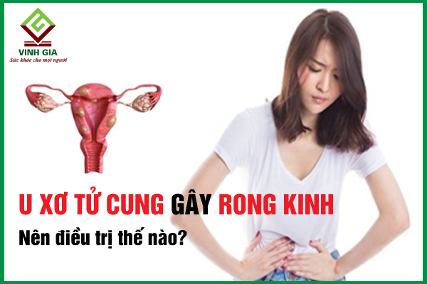 Nguyên nhân u xơ tử cung gây rong kinh