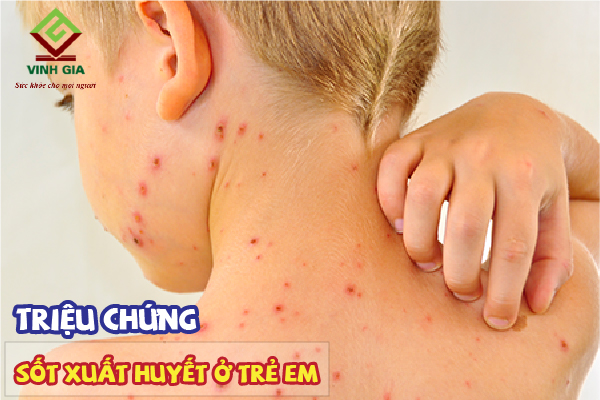 Những dấu hiệu thường gặp ở trẻ em bị sốt xuất huyết