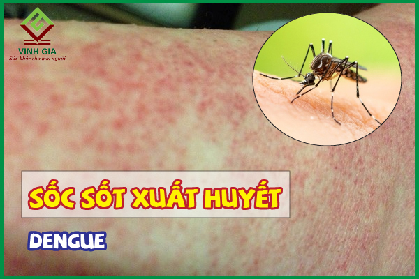 Cách xử lý khi bị sốc sốt xuất huyết Dengue