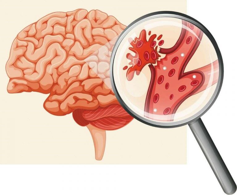 NGUY CƠ CAO BỊ ĐỘT QUỴ Ở NGƯỜI BỆNH TIM MẠCH VÀ GIẢI PHÁP NGĂN NGỪA SỚM