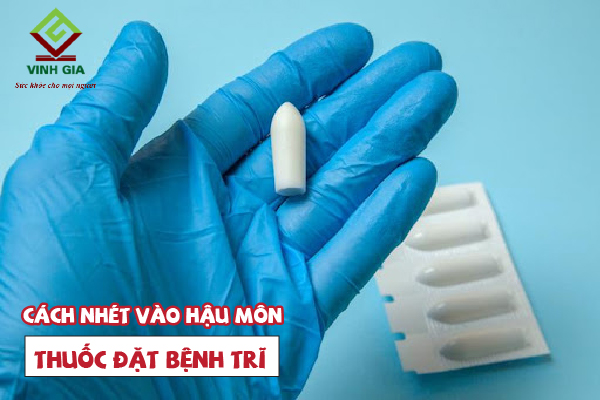 Cách đặt thuốc trĩ vào hậu môn như thế nào cho đúng? Cách đặt thuốc trĩ vào hậu môn như thế nào cho đúng?