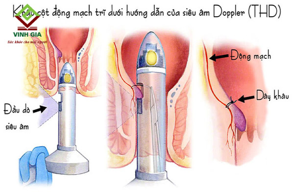 Phẫu thuật khâu triệt mạch trĩ dưới hướng dẫn của siêu âm doppler (THD) là cách chữa bệnh trĩ đơn giản mà hiệu quả