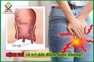 Bệnh trĩ có chữa dứt điểm được không và chữa bằng cách nào?