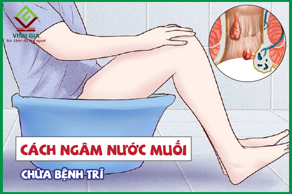 Cách ngâm nước muối làm dịu cơn đau trĩ có hiệu quả không?