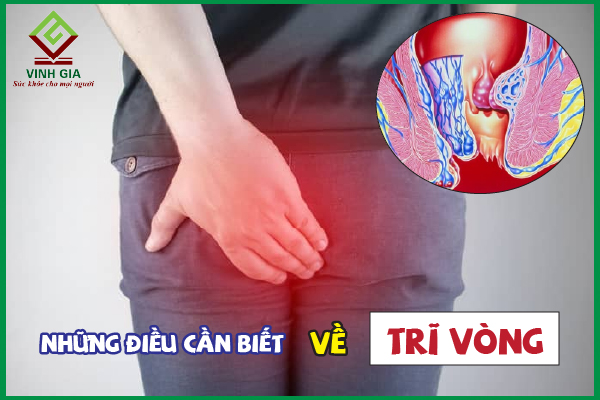 Bệnh trĩ vòng là gì? Các biện pháp làm dịu cơn đau hiệu quả