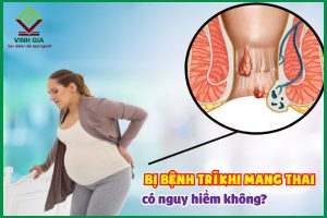 Bị bệnh trĩ khi mang thai có nguy hiểm hay không?