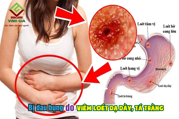 Bị đau bụng có thể là do bệnh viêm loét dạ dày, tá tràng