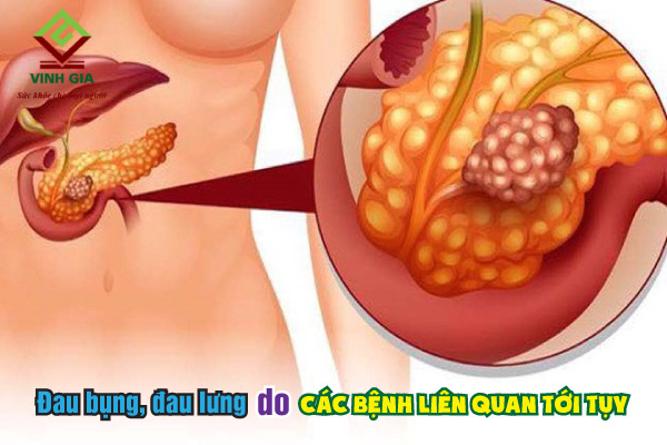 Các bệnh liên quan tới tụy cũng dễ gây đau âm ỉ ở bụng và lưng