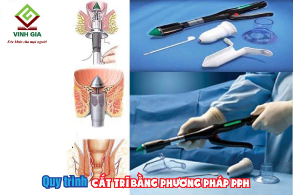 Các bước trong quy trình thực hiện cắt búi trĩ bằng phương pháp PPH