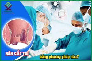 Cắt trĩ bằng phương pháp nào tốt nhất, không đau và nhanh lành?