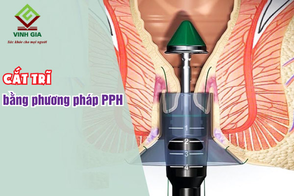 Cắt trĩ bằng phương pháp PPH giúp loại bỏ nhanh búi trĩ, ít gây đau đớn