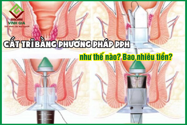 Cắt trĩ bằng phương pháp PPH là gì? Giá bao nhiêu?
