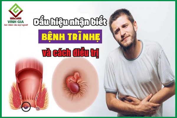 Dấu hiệu nhận biết bệnh trĩ nhẹ và cách khắc phục hiệu quả