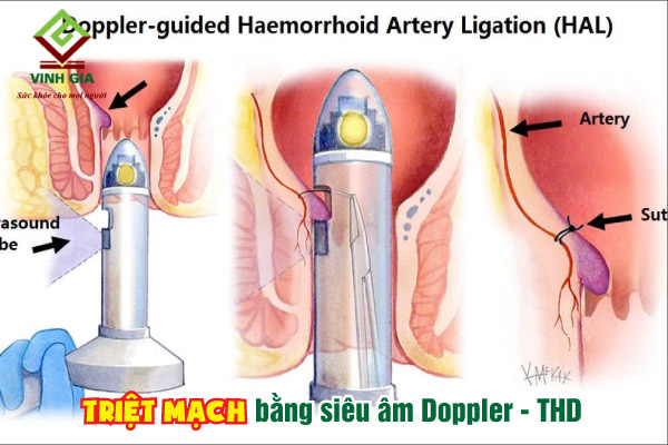 Phẫu thuật trĩ bằng phương pháp siêu âm Doppler - THD