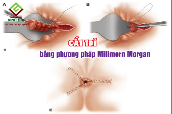 Phương pháp phẫu thuật cắt trĩ bằng Milimorn Morgan cho hiệu quả cao, tỉ lệ tái phát thấp