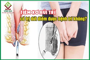 Tiêm xơ búi trĩ có hiệu quả và có “dứt điểm” bệnh không?