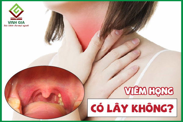 Viêm họng có lây không và cách tránh lây nhiễm?