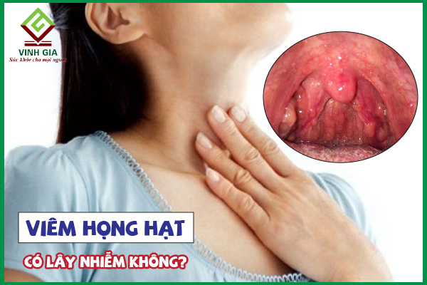 Bệnh viêm họng hạt có lây không? Phòng ngừa như thế nào?