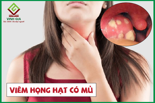 Viêm họng hạt có mủ: Nguyên nhân và cách điều trị hiệu quả