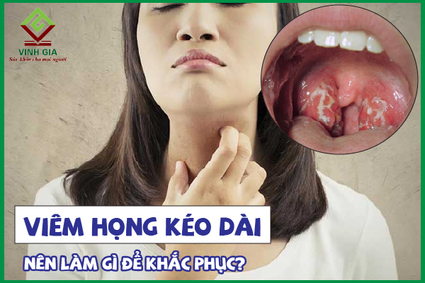 Viêm họng kéo dài: Nên làm gì để phòng và điều trị hiệu quả?