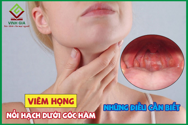 Viêm họng nổi hạch góc hàm có đáng lo không?