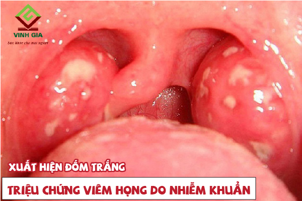 Xuất hiện đốm trắng trong họng là dấu hiệu của bệnh viêm họng nhiễm khuẩn