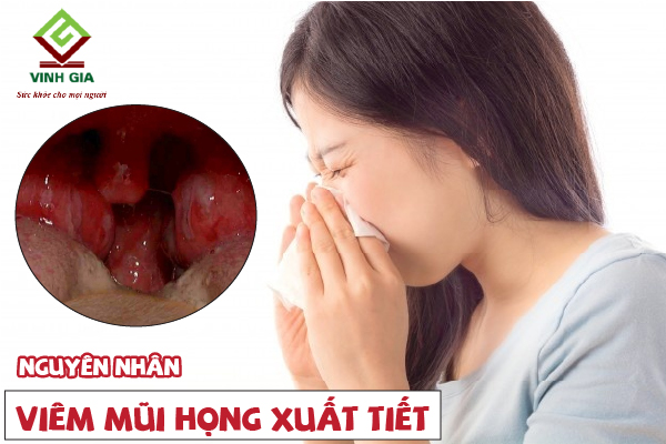 Bị viêm mũi họng xuất tiết do những nguyên nhân nào gây nên?