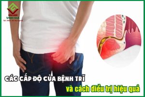 Các cấp độ của bệnh trĩ và cách điều trị hiệu quả nhất