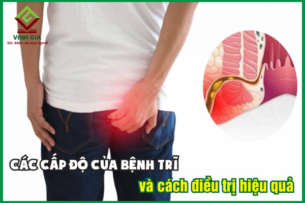 Các cấp độ của bệnh trĩ biểu hiện như thế nào?